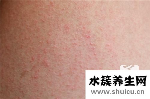 維a酸乳膏治扁平疣