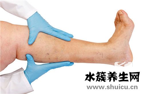 靜脈曲張預(yù)防