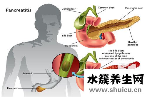膽囊壁膽固醇結晶