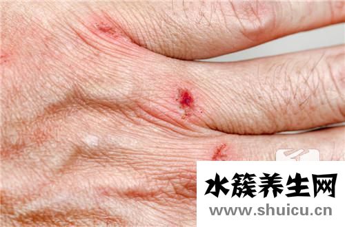 被老鼠抓傷了怎么辦