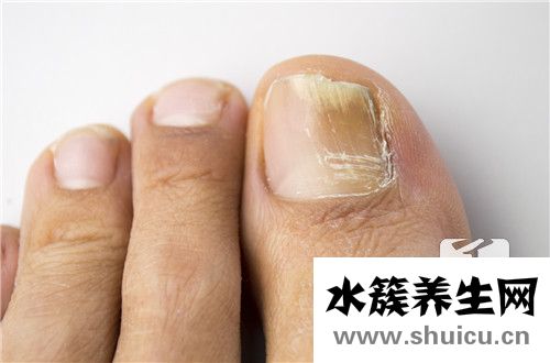 指甲往肉里長怎么辦