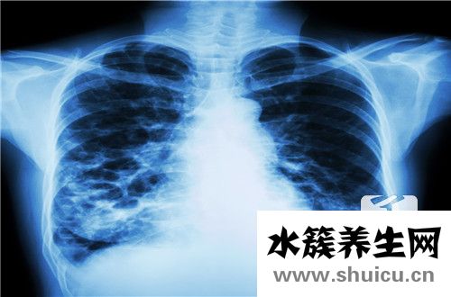 肺部結(jié)節(jié)是怎么回事