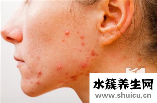 夫西地酸乳膏治痘痘