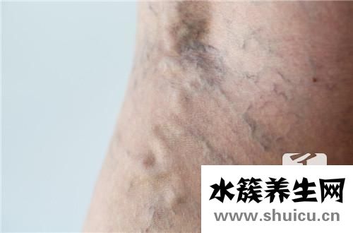 上腔靜脈阻塞綜合征