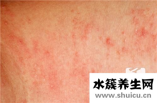 汗皰疹最佳治療方法