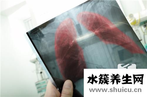 肺間質纖維化能活多久