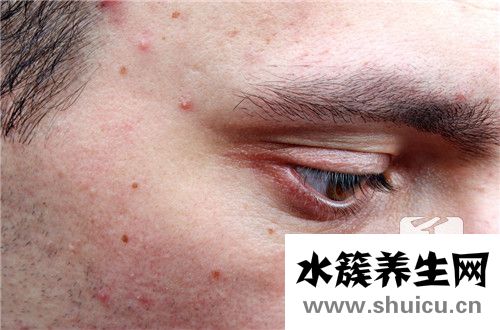 痘坑怎么修復簡單方法