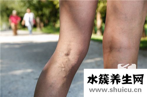 下肢深靜脈血栓后遺癥