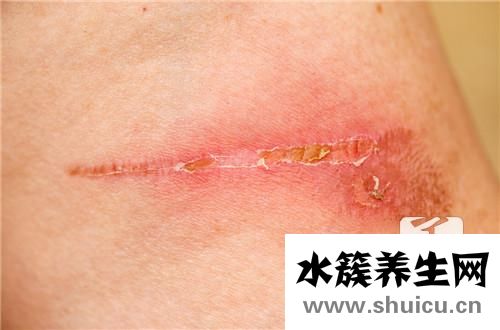 結痂后怎樣不留疤痕