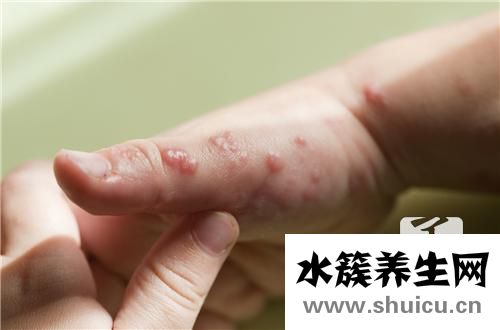 怎么治療脂溢性皮炎