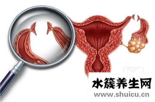 中醫(yī)治療輸卵管堵塞