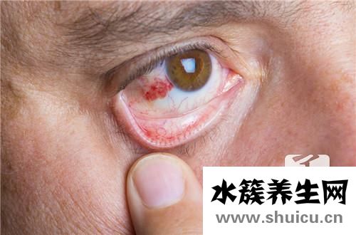 紅眼病的治療方法