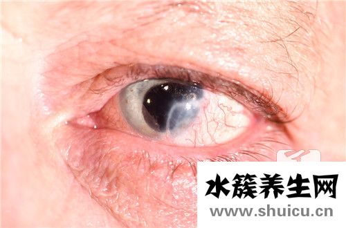 紅眼病的治療方法