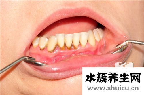 四環(huán)素牙是什么