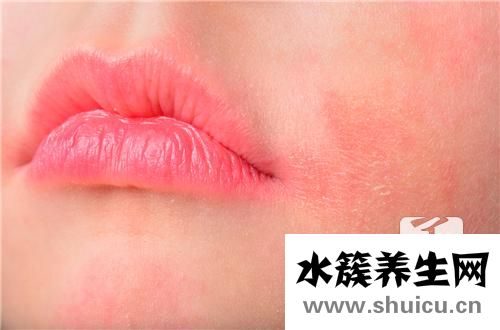 激素依賴性皮炎癥狀