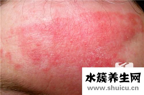 得了濕疹不能吃什么