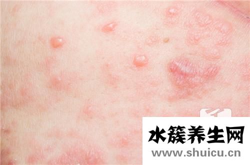 中醫治療尋麻疹