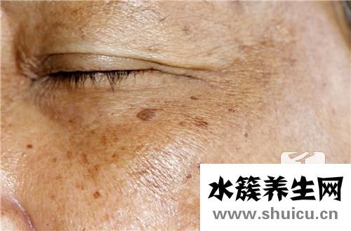 傳染性軟疣怎么治療