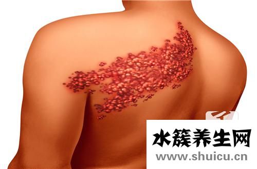 病毒性皰疹傳染嗎