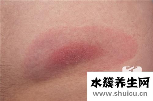 過敏性紫癜好治嗎