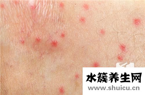 過敏性紫癜好治嗎