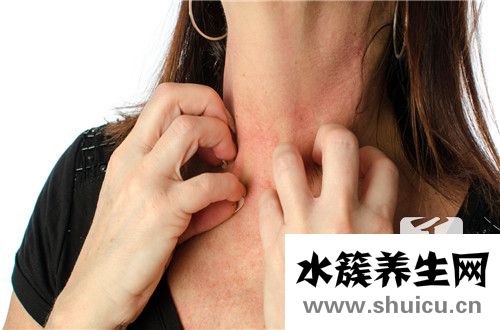 過敏性皮炎如何治療