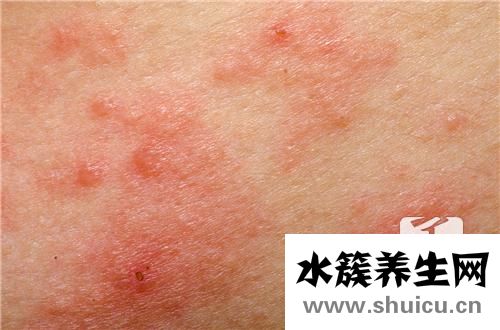 尋麻疹如何治療