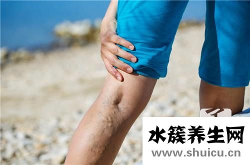 什么是靜脈曲張