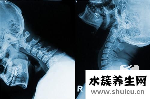 怎樣緩解頸椎疼痛
