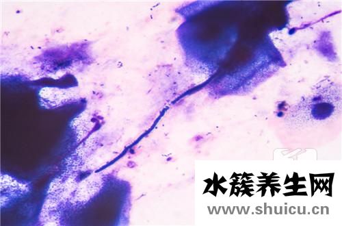 鏈球菌感染怎么治療