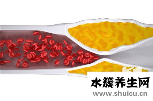 高甘油三酯血癥