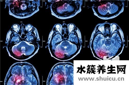 彌漫性軸索損傷