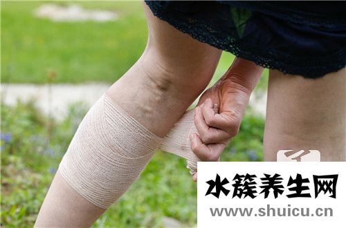 靜脈曲張怎么治