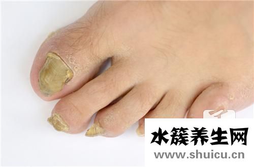 甲溝炎用什么藥