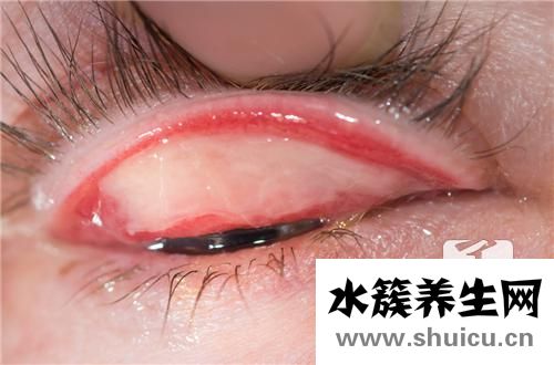 眼結(jié)石怎么治療