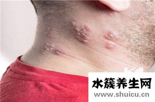 帶狀皰疹吃什么藥