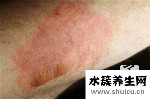 身上長紅痣是什么原因