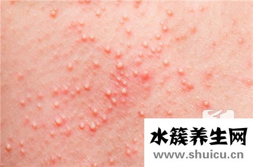 玫瑰糠疹怎么引起的