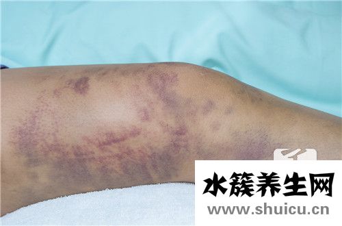 傷口化膿怎么處理