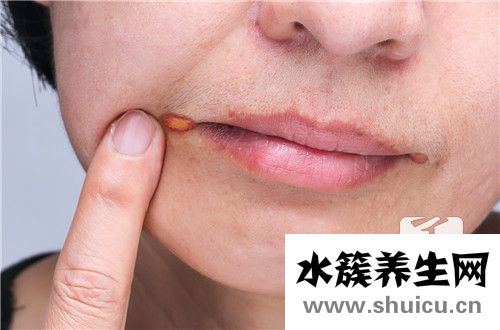 口腔內(nèi)壁發(fā)白