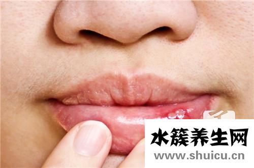 潰瘍的白色刮掉會(huì)怎樣