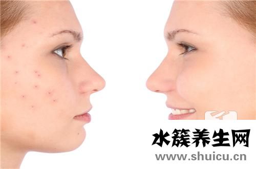 痘痘癢是怎么回事