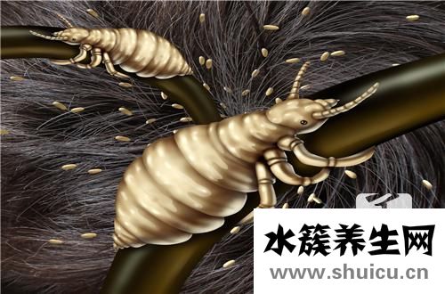 頭發上長虱子怎么辦