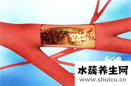 腦血管堵塞癥狀