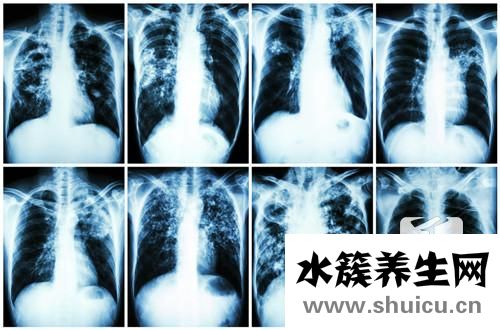 怎么會引起肺磨玻璃影