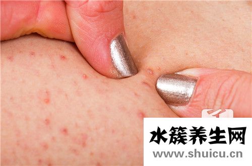 治療毛囊炎最有效的藥