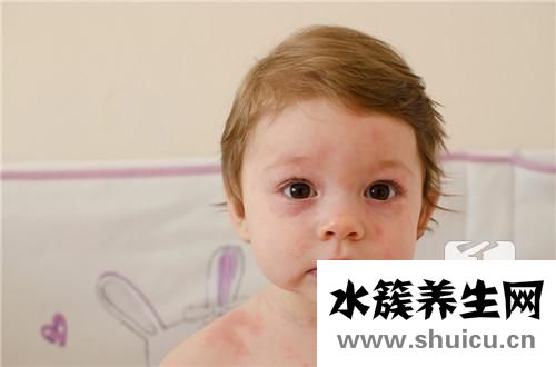 新生兒臉上濕疹小妙招