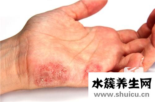 皰疹用什么藥膏最有效