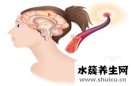 腦白質(zhì)缺血性改變