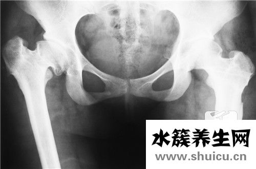 致密性骶髂關節炎